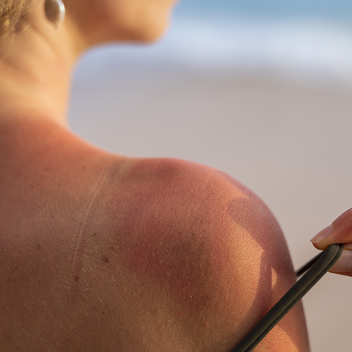 Melanoma: 5 Scottature Solari Prima dei 20 Anni Aumentano il Rischio dell’80%